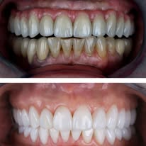 Blanchiment dentaire - Cas 2